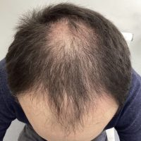 before non surgical hair treatment 3