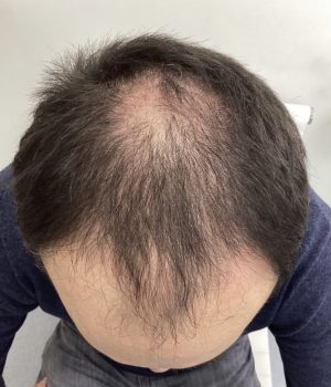 before non surgical hair treatment 3