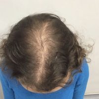 before non surgical hair treatment 4