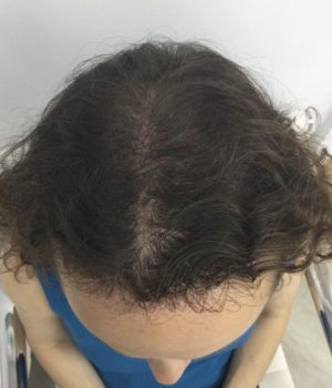 after non surgical hair treatment 4