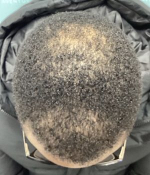 before non surgical hair treatment 5