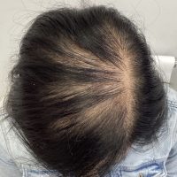 before non surgical hair treatment 6