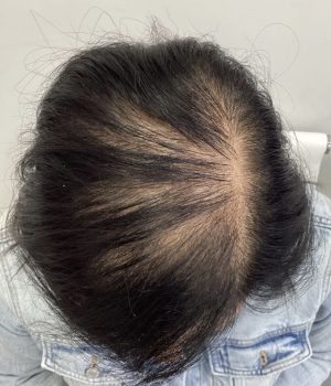 before non surgical hair treatment 6