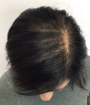 after non surgical hair treatment 6