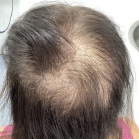 before non surgical hair treatment 7