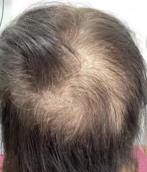 before non surgical hair treatment 7