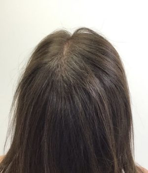 after non surgical hair treatment 7