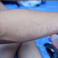 Itching​
