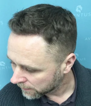 Lee-After