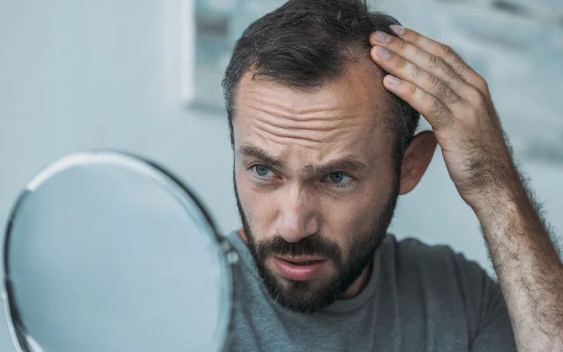 Male-Hair-Loss