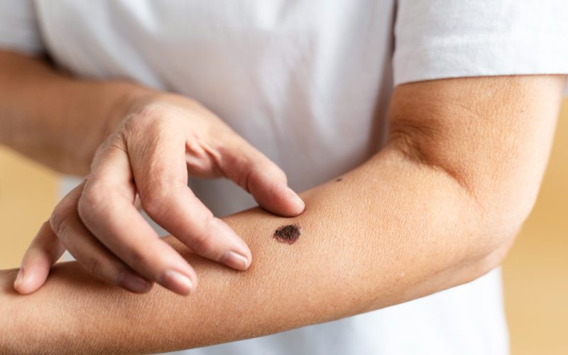Mole-Check