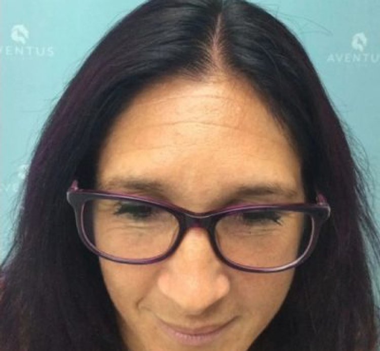 Non-Surgical Hair Treatment After 6