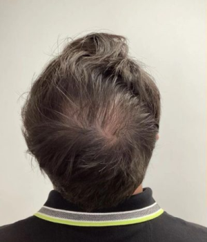 Non-Surgical Hair Treatment Before 4