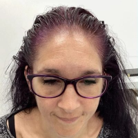 Non-Surgical Hair Treatment Before 5