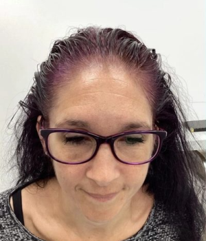 Non-Surgical Hair Treatment Before 5