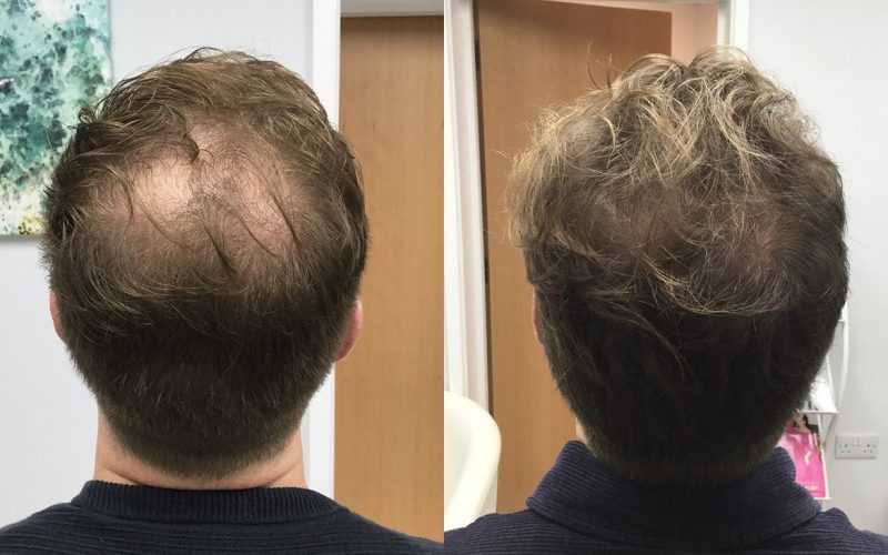 Non-Surgical-Hair-Treatment-Before-And-After-1