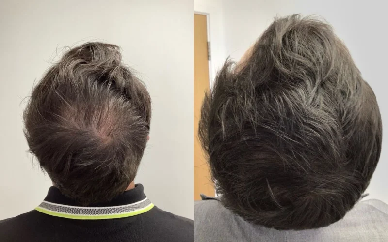 Non Surgical Hair Treatment Before And After