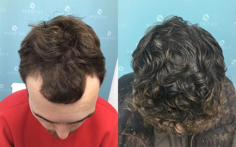 Non-Surgical-Hair-Treatment-Before-And-After2