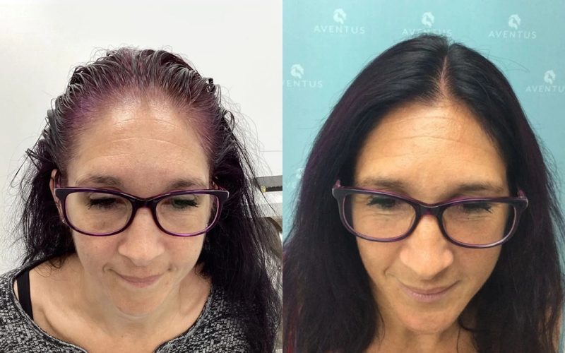 Non-Surgical-Hair-Treatment-Before-And-After3