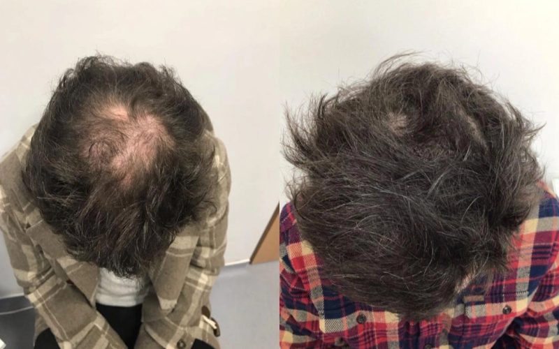Non-Surgical-Hair-Treatment-Before-And-After4