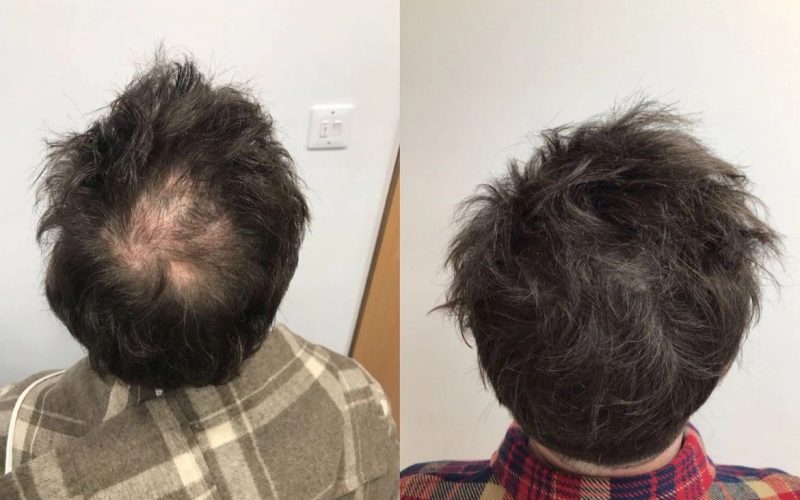 Non-Surgical-Hair-Treatment-Before-And-After5