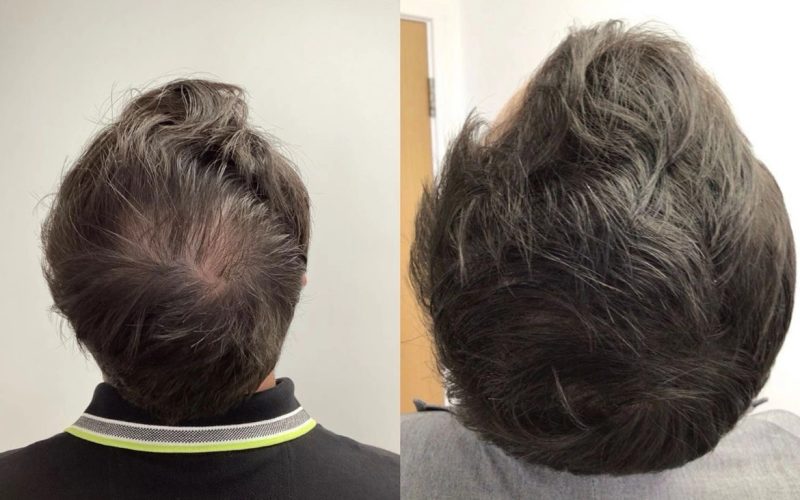 Non-Surgical-Hair-Treatment-Before-And-After6