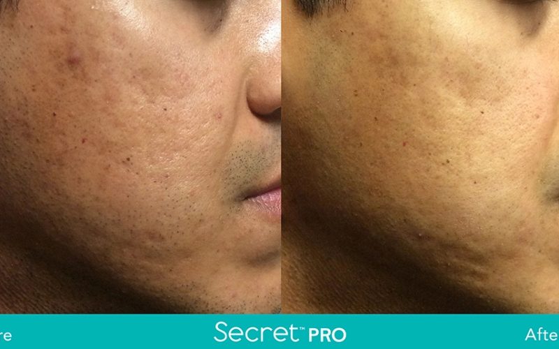 Secret-Pro-Before-And-After