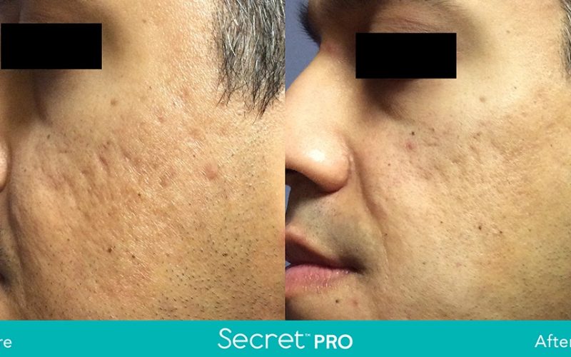 Secret-Pro-Before-And-After1