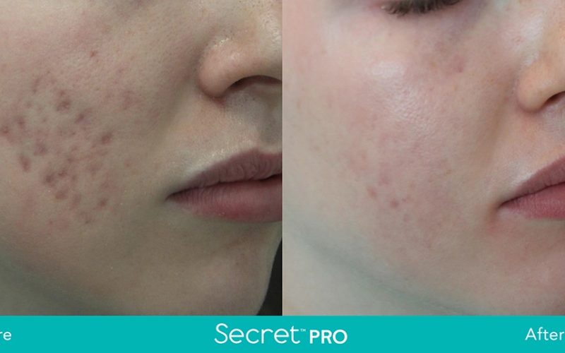 Secret-Pro-Before-And-After10