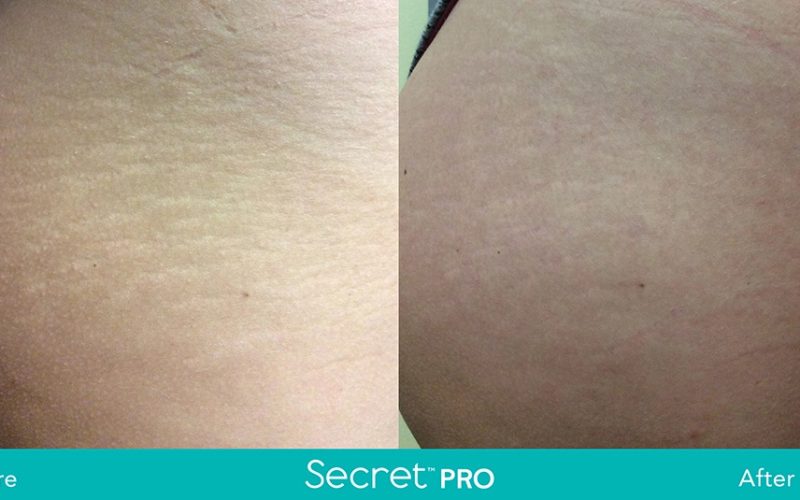 Secret-Pro-Before-And-After2