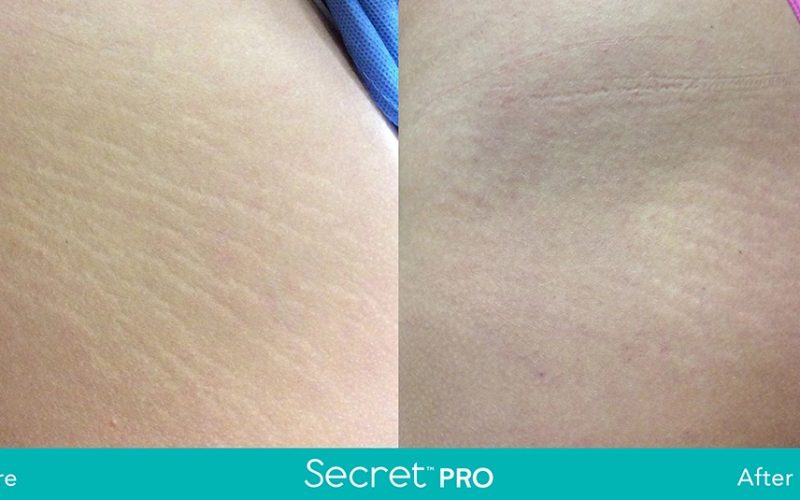 Secret-Pro-Before-And-After3