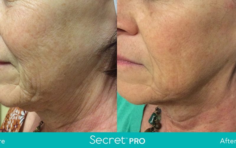 Secret-Pro-Before-And-After4