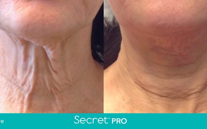 Secret-Pro-Before-And-After5