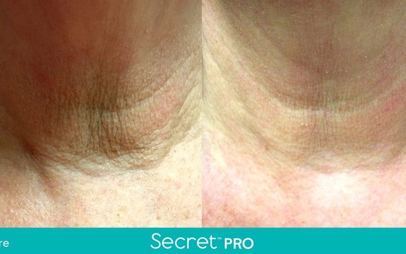 Secret-Pro-Before-And-After6