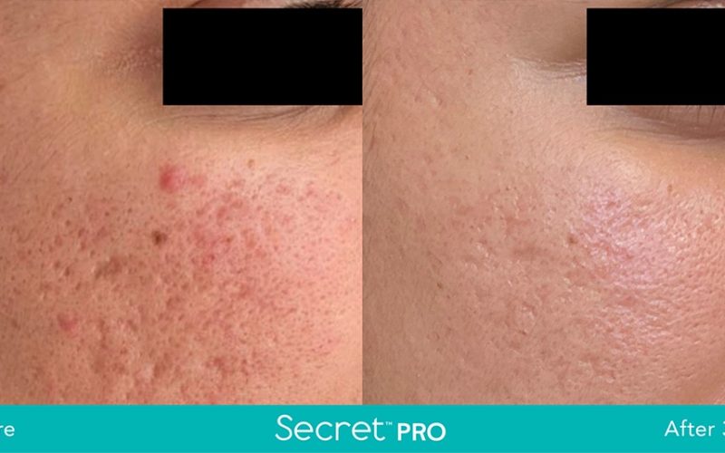 Secret-Pro-Before-And-After7