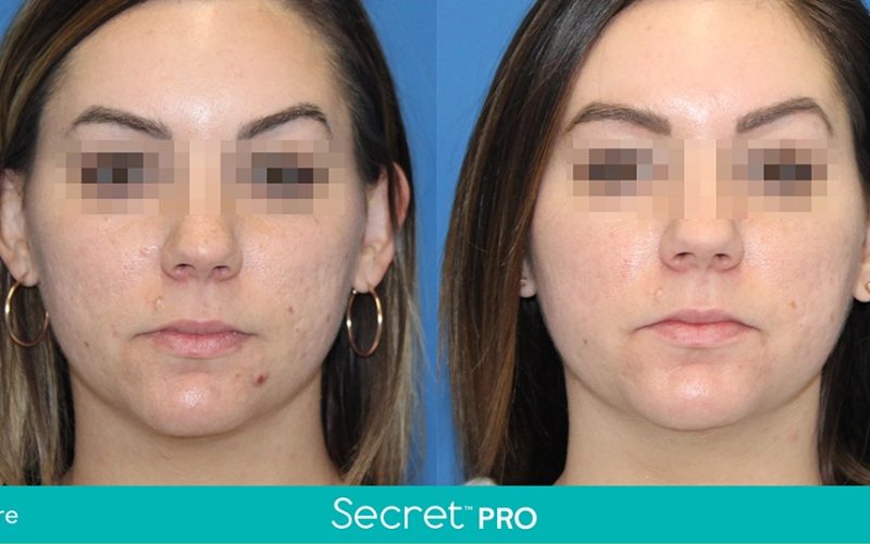 Secret-Pro-Before-And-After8