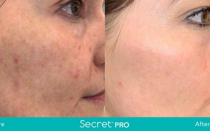 Secret-Pro-Before-And-After9
