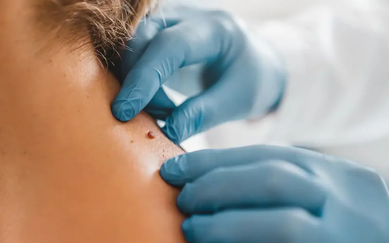 Skin-Tag-On-Neck