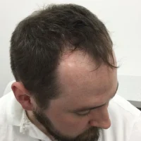 Thomas-Before