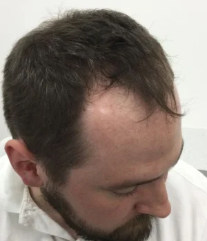 Thomas-Before