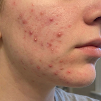 acne before