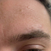 after image eyebrow cyst