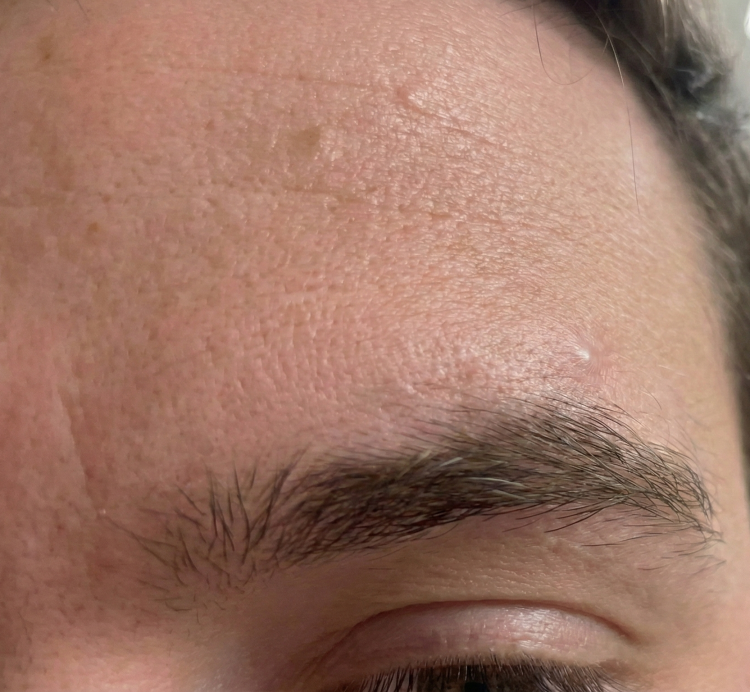 after image eyebrow cyst
