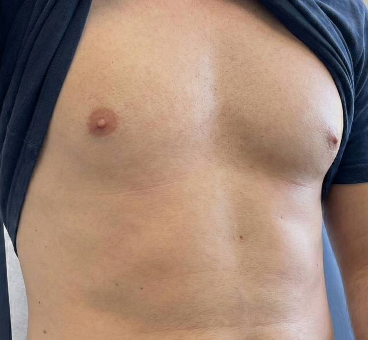 after men laser hair removal