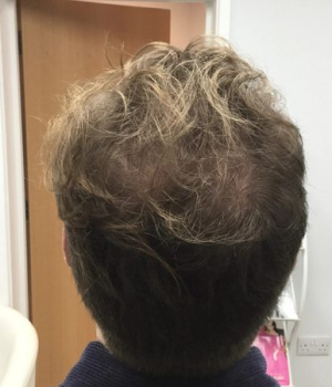 after non surgical hair treatment 1