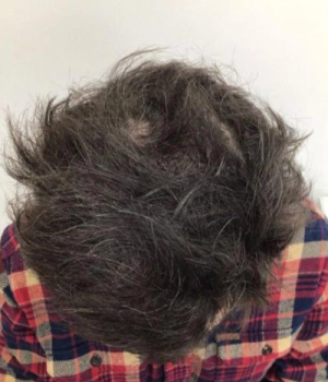 after non surgical hair treatment 3