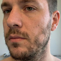 before beard transplant 1