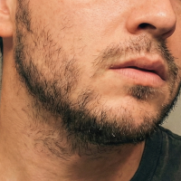 before beard transplant 2