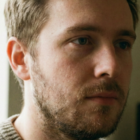 before beard transplant 3