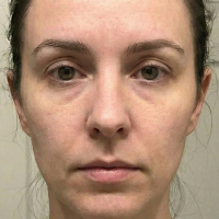 before eyebrow transplant 1